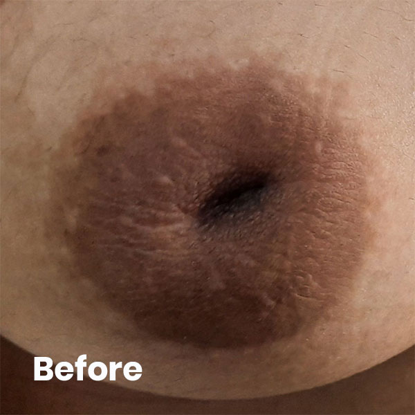 inverted nipple piercing in india