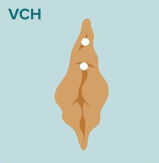 Vertical Clitoral Hood (VCH)